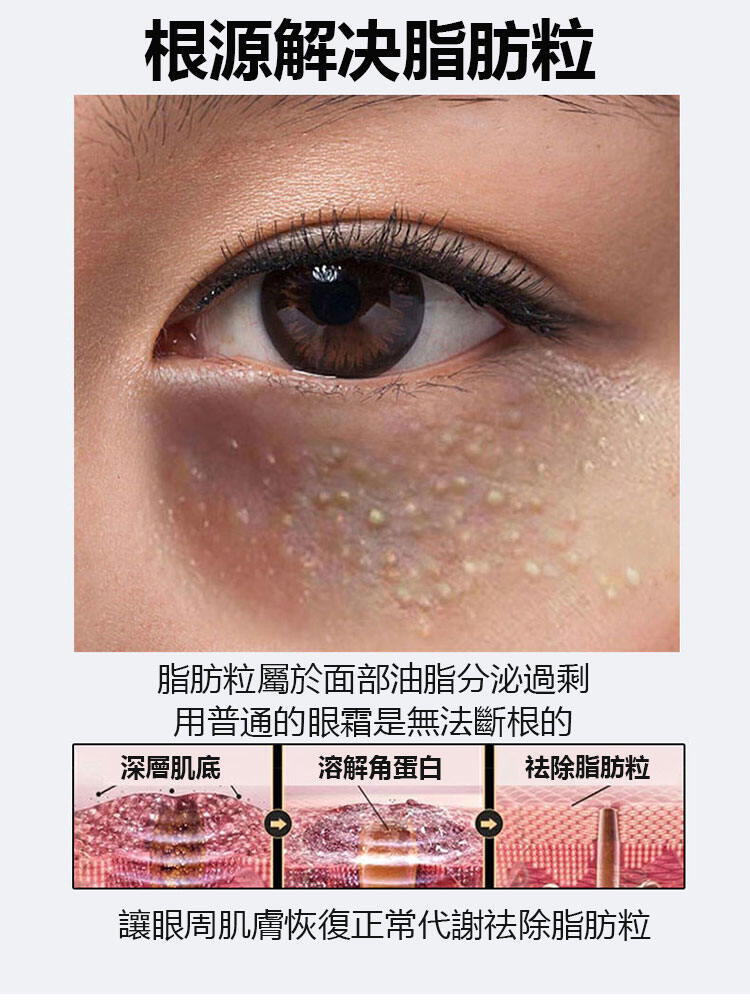 52cb7f3f4351838759b35f485fffbbf1 脂肪粒祛除精華液