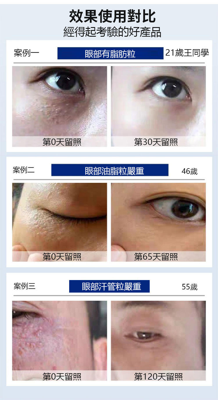a9e7b136477532c73266846efc63af66 脂肪粒祛除精華液