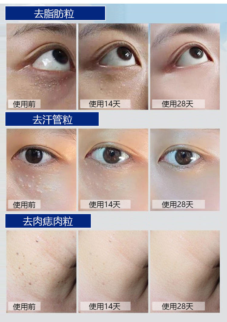 e8a1dcc5423da522b5610852f4758915 脂肪粒祛除精華液